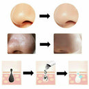 Aspiratori punti neri per la pulizia del viso